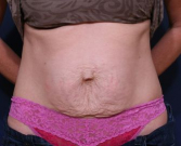 Feel Beautiful - Tummy Tuck Times Two - Before Photo